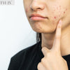 Acne Fighters: The Best Ingredients to Look for in Skincare Products